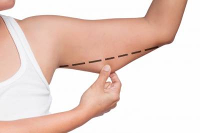 Arm Lift | Brachioplasty